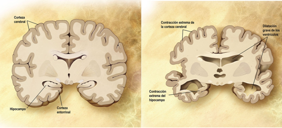 Alzheimer, por Rebeca Voto